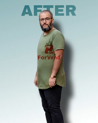 After Bariatric Surgery 2