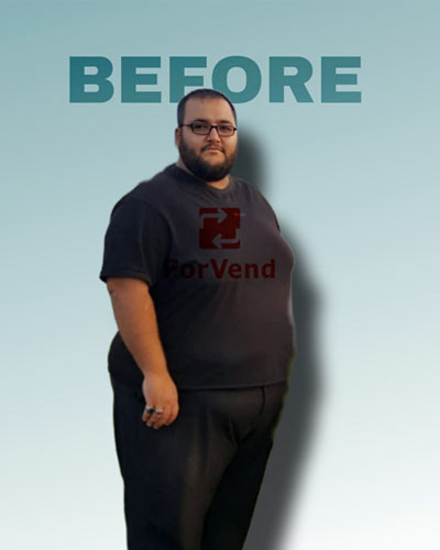 Befor Bariatric Surgery 2